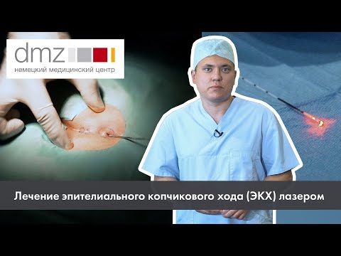 Лечение эпителиального копчикового хода лазером