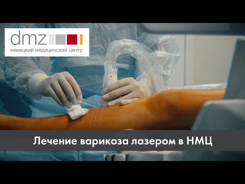 Видео НМЦ о лечении варикоза лазером